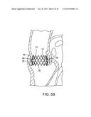 PROSTHETIC HEART VALVE DELIVERY APPARATUS diagram and image