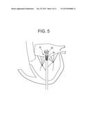 TRUNCATED CONE HEART VALVE STENT diagram and image