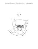 TRUNCATED CONE HEART VALVE STENT diagram and image