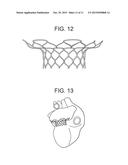 TRUNCATED CONE HEART VALVE STENT diagram and image