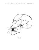 MANDIBULAR ADVANCEMENT DEVICE diagram and image