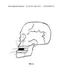 MANDIBULAR ADVANCEMENT DEVICE diagram and image