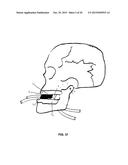 MANDIBULAR ADVANCEMENT DEVICE diagram and image