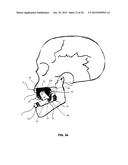 MANDIBULAR ADVANCEMENT DEVICE diagram and image