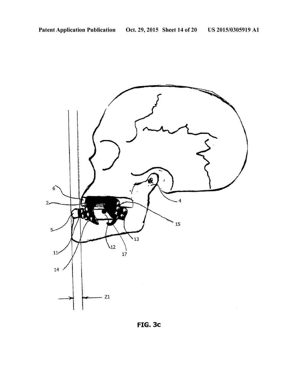 MANDIBULAR ADVANCEMENT DEVICE - diagram, schematic, and image 15