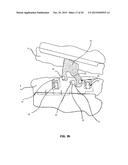 MANDIBULAR ADVANCEMENT DEVICE diagram and image