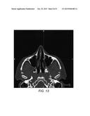 TREATMENT OF HEADACHE BY INJECTION OF NEUROINHIBITORY SUBSTANCE TO     SPHENOPALATINE GANGLION OR OTIC GANGLION diagram and image