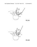 DEVICES AND METHODS FOR TREATING TISSUE diagram and image