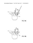 DEVICES AND METHODS FOR TREATING TISSUE diagram and image