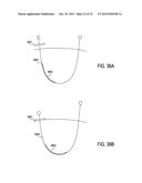 DEVICES AND METHODS FOR TREATING TISSUE diagram and image