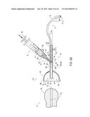 Catheter Guide and Method for Utilizing the Same diagram and image