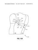 Method and System to Subdivide a Mapping Area for Mechanical Activation     Analysis diagram and image