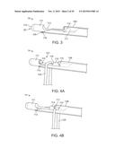 NEEDLE AND SNARE GUIDE APPARATUS FOR PASSING SUTURE diagram and image