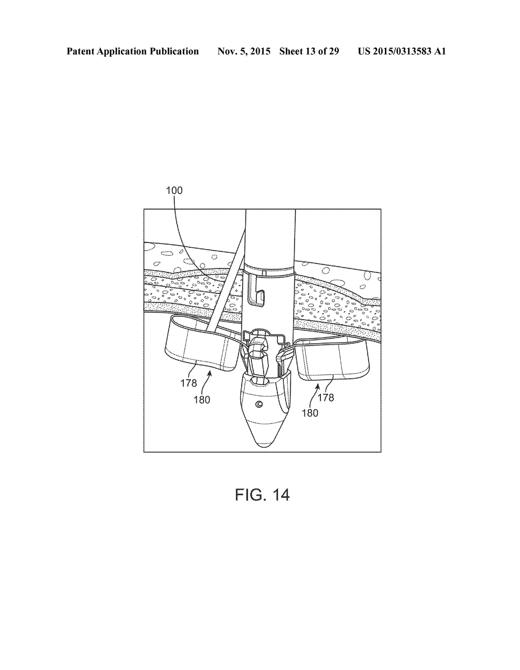 NEEDLE AND SNARE GUIDE APPARATUS FOR PASSING SUTURE - diagram, schematic, and image 14