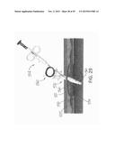 NEEDLE AND SNARE GUIDE APPARATUS FOR PASSING SUTURE diagram and image