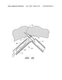 METHOD OF CLOSING AN OPENING IN A WALL OF THE HEART diagram and image