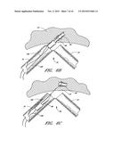 METHOD OF CLOSING AN OPENING IN A WALL OF THE HEART diagram and image