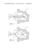 METHOD OF CLOSING AN OPENING IN A WALL OF THE HEART diagram and image