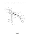 NONINVASIVE PROTECTION FROM EMBOLI diagram and image