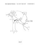 NONINVASIVE PROTECTION FROM EMBOLI diagram and image