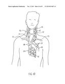 NONINVASIVE PROTECTION FROM EMBOLI diagram and image