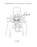 NONINVASIVE PROTECTION FROM EMBOLI diagram and image