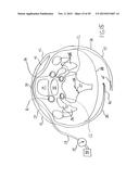 NONINVASIVE PROTECTION FROM EMBOLI diagram and image