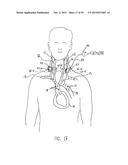 NONINVASIVE PROTECTION FROM EMBOLI diagram and image