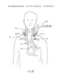 NONINVASIVE PROTECTION FROM EMBOLI diagram and image