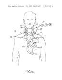 NONINVASIVE PROTECTION FROM EMBOLI diagram and image