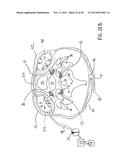 NONINVASIVE PROTECTION FROM EMBOLI diagram and image