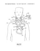 NONINVASIVE PROTECTION FROM EMBOLI diagram and image