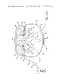 NONINVASIVE PROTECTION FROM EMBOLI diagram and image