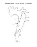 AORTIC DISSECTION SEPTAL CUTTING TOOL diagram and image