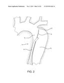 AORTIC DISSECTION SEPTAL CUTTING TOOL diagram and image