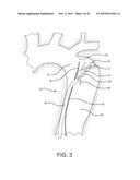 AORTIC DISSECTION SEPTAL CUTTING TOOL diagram and image