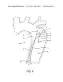 AORTIC DISSECTION SEPTAL CUTTING TOOL diagram and image