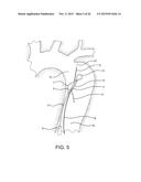 AORTIC DISSECTION SEPTAL CUTTING TOOL diagram and image