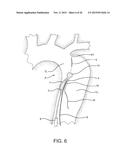 AORTIC DISSECTION SEPTAL CUTTING TOOL diagram and image