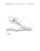 Solid Introducer Needle for Catheter diagram and image