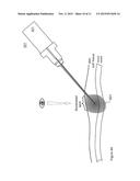 Solid Introducer Needle for Catheter diagram and image