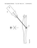 Solid Introducer Needle for Catheter diagram and image