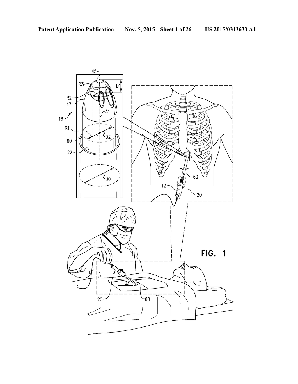 PERICARDIAL ACCESS DEVICE - diagram, schematic, and image 02