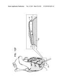 PERICARDIAL ACCESS DEVICE diagram and image