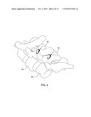 MINIMALLY INVASIVE SPINAL COLUMN REALIGNMENT SYSTEM AND METHOD diagram and image