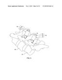 MINIMALLY INVASIVE SPINAL COLUMN REALIGNMENT SYSTEM AND METHOD diagram and image