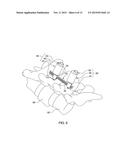 MINIMALLY INVASIVE SPINAL COLUMN REALIGNMENT SYSTEM AND METHOD diagram and image