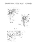 CONFORMING BONE STABILIZATION RECEIVER diagram and image