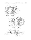 CONFORMING BONE STABILIZATION RECEIVER diagram and image