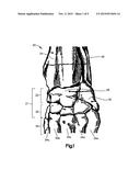 Pancarpal Arthrodesis Bone Plate diagram and image